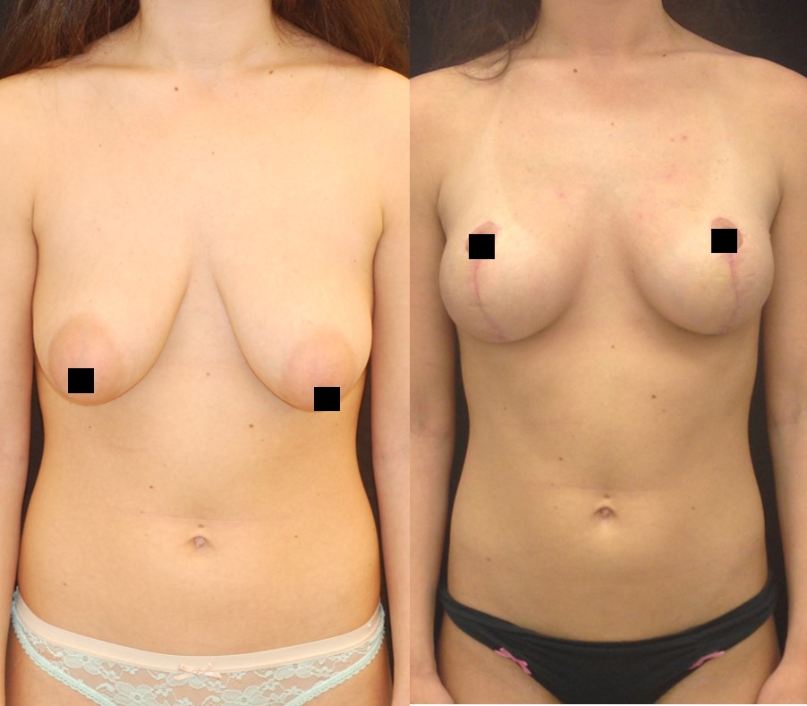 Boob Lift Before And After 85