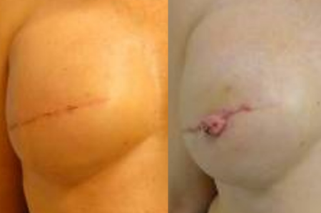 Nipple Reconstruction Surgery 71