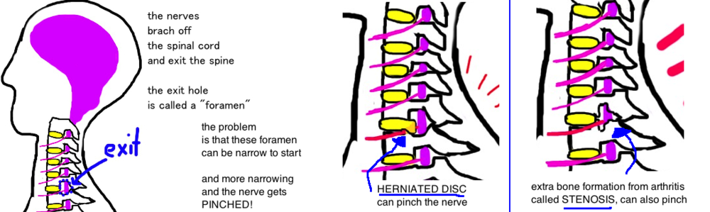 Spine - Cervical Radiculopathy (Pinched Nerve in the Neck) — Bone Talks