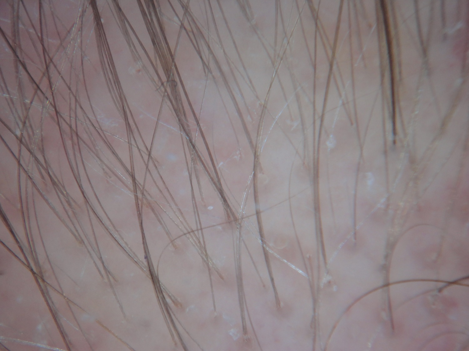 Treating seborrheic dermatitis in androgenetic alopecia: Make it a part of  the plan — Donovan Hair Clinic