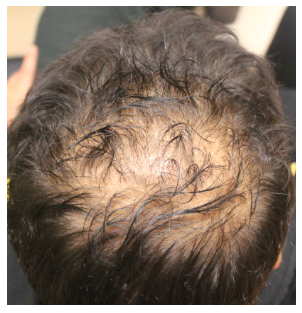 Steroid injections for alopecia areata
