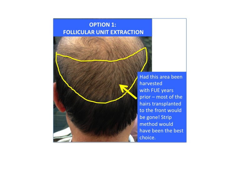 Should I get FUE or strip hair transplant surgery ? — Donovan Hair Clinic