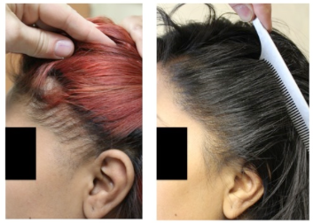 Traction Alopecia in Black Women : Is hair transplant an option? — Donovan  Hair Clinic