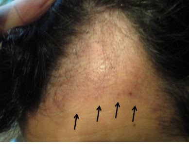Redness after a hair transplant — Donovan Hair Clinic