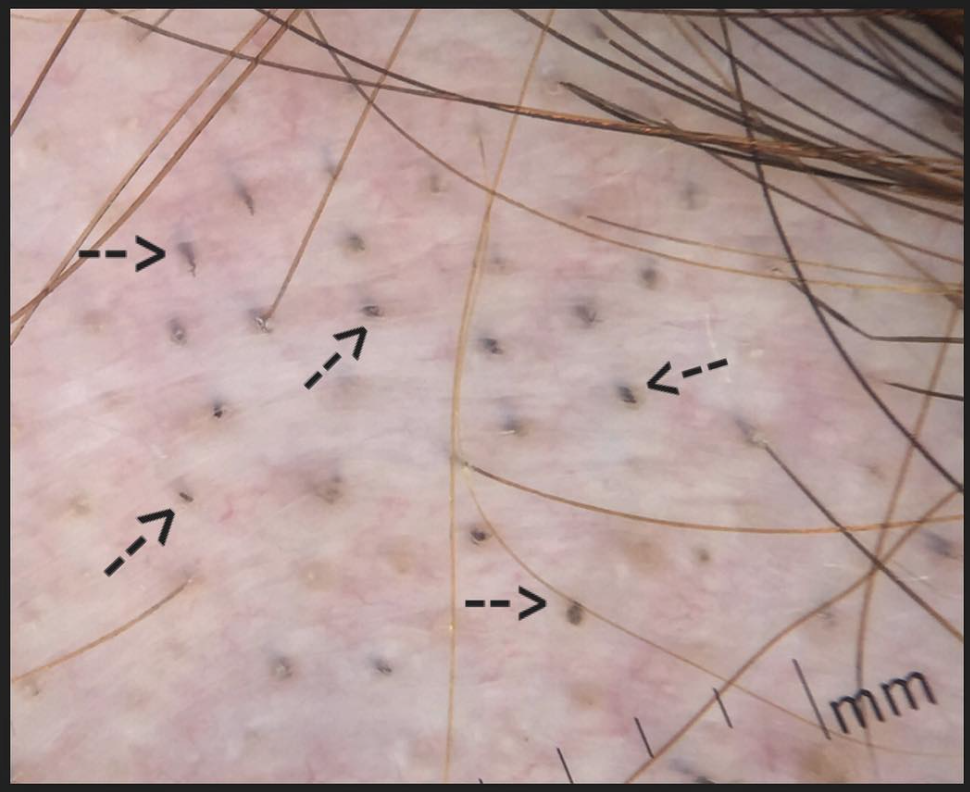 Black dots in alopecia areata — Donovan Hair Clinic