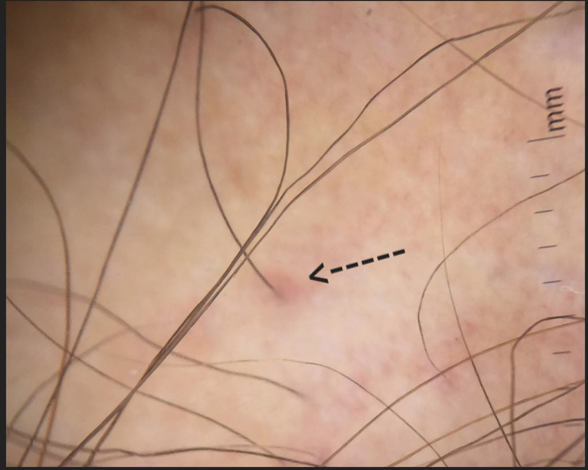 Redness around hair follicles: What does in mean in frontal fibrosing  alopecia (FFA)? — Donovan Hair Clinic