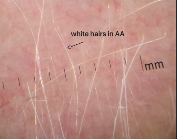 Alopecia Areata — Donovan Hair Clinic