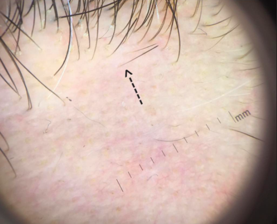 Exclamation mark hairs in Alopecia Areata are located at the periphary —  Donovan Hair Clinic