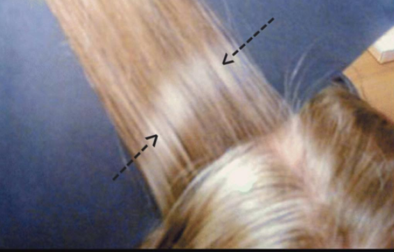 Drug Induced hair colour changes — Donovan Hair Clinic
