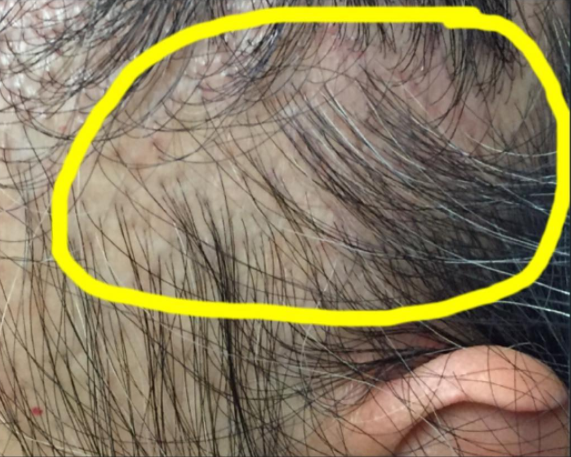 hair loss in women — Donovan Hair Clinic