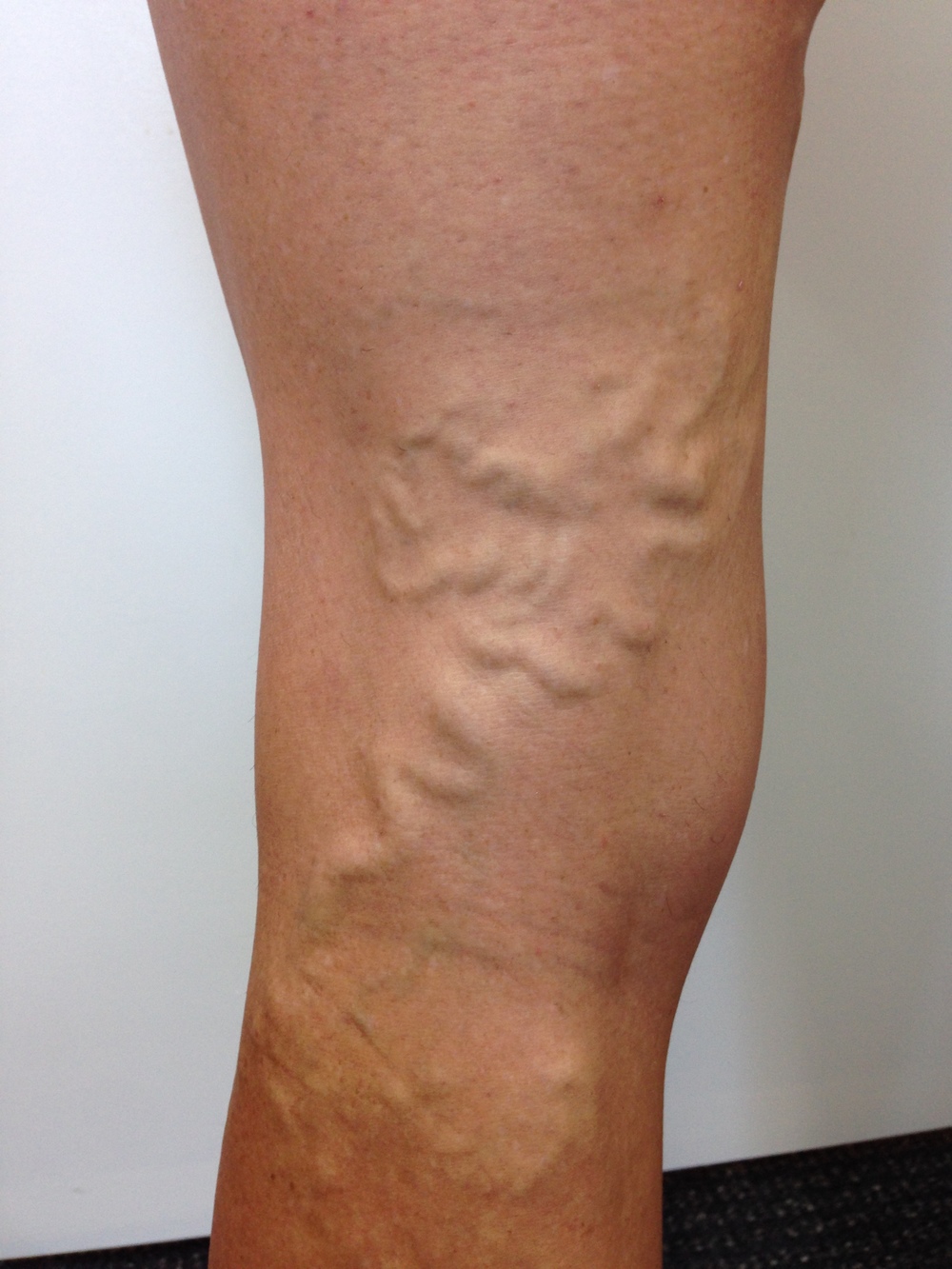 Venous Leg Ulcers. What are leg ulcers? Causes and ...