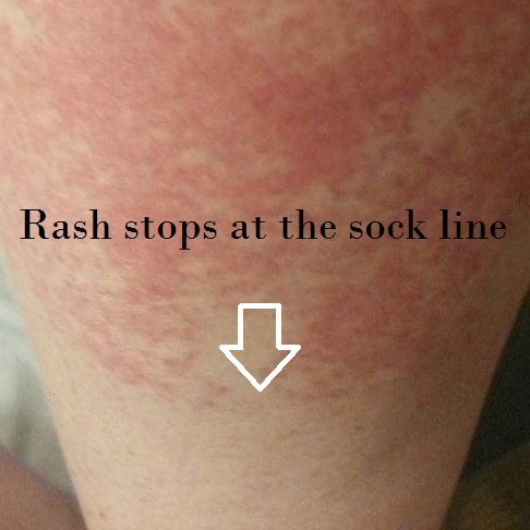 red rash around neck