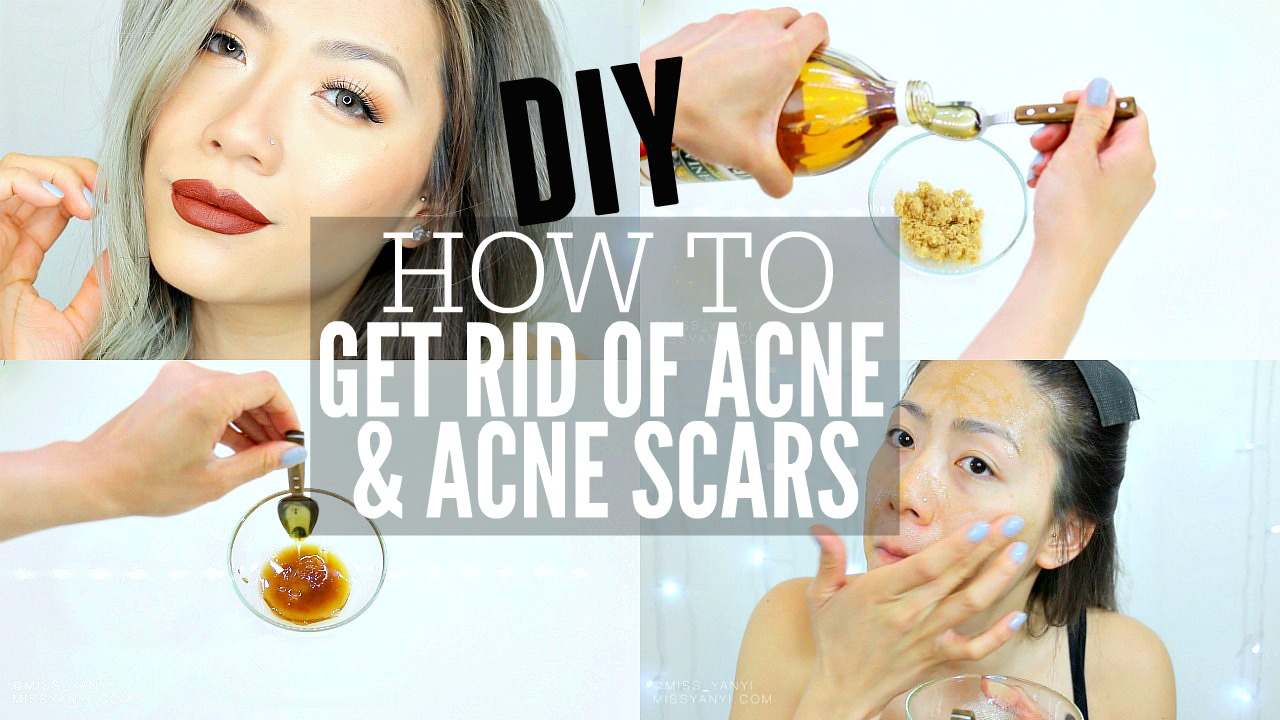 how to get rid of acne & acne scars fast at home! | diy apple cider