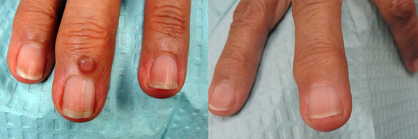 Nail Case Studies — Dr. Dana Stern | Dermatologist | Nail Specialist