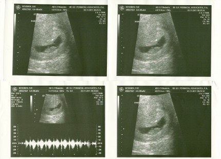 Week 8 Ultrasound