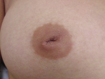 Female Inverted Nipples 51