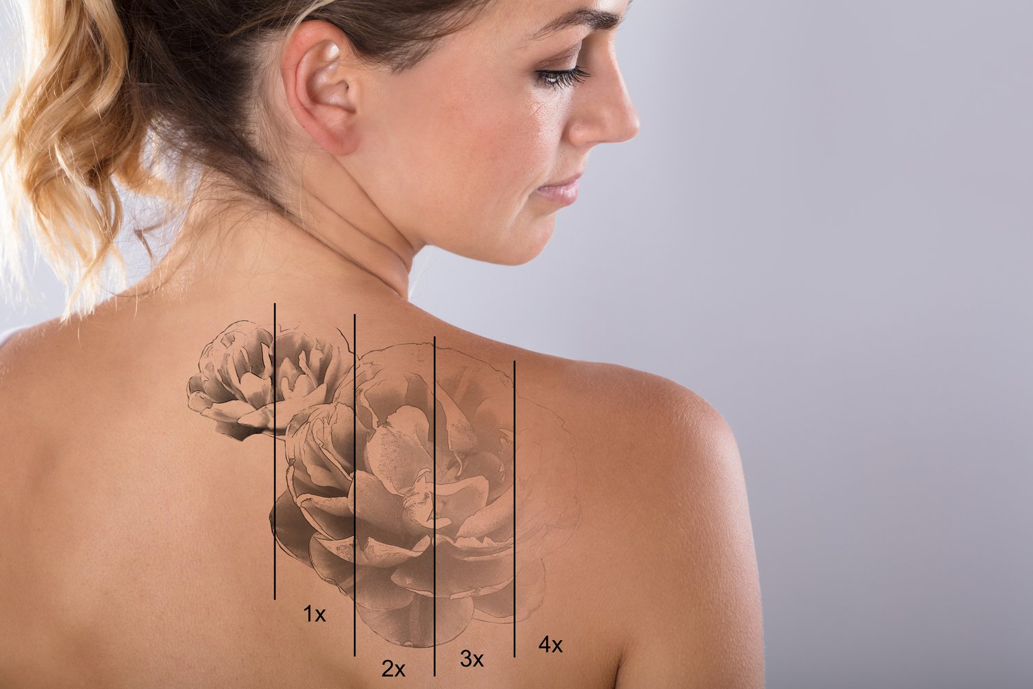 Laser Tattoo Removal Treatment & Prices — Lumiere Medispa - Skin Health &  Rejuvenation Clinic