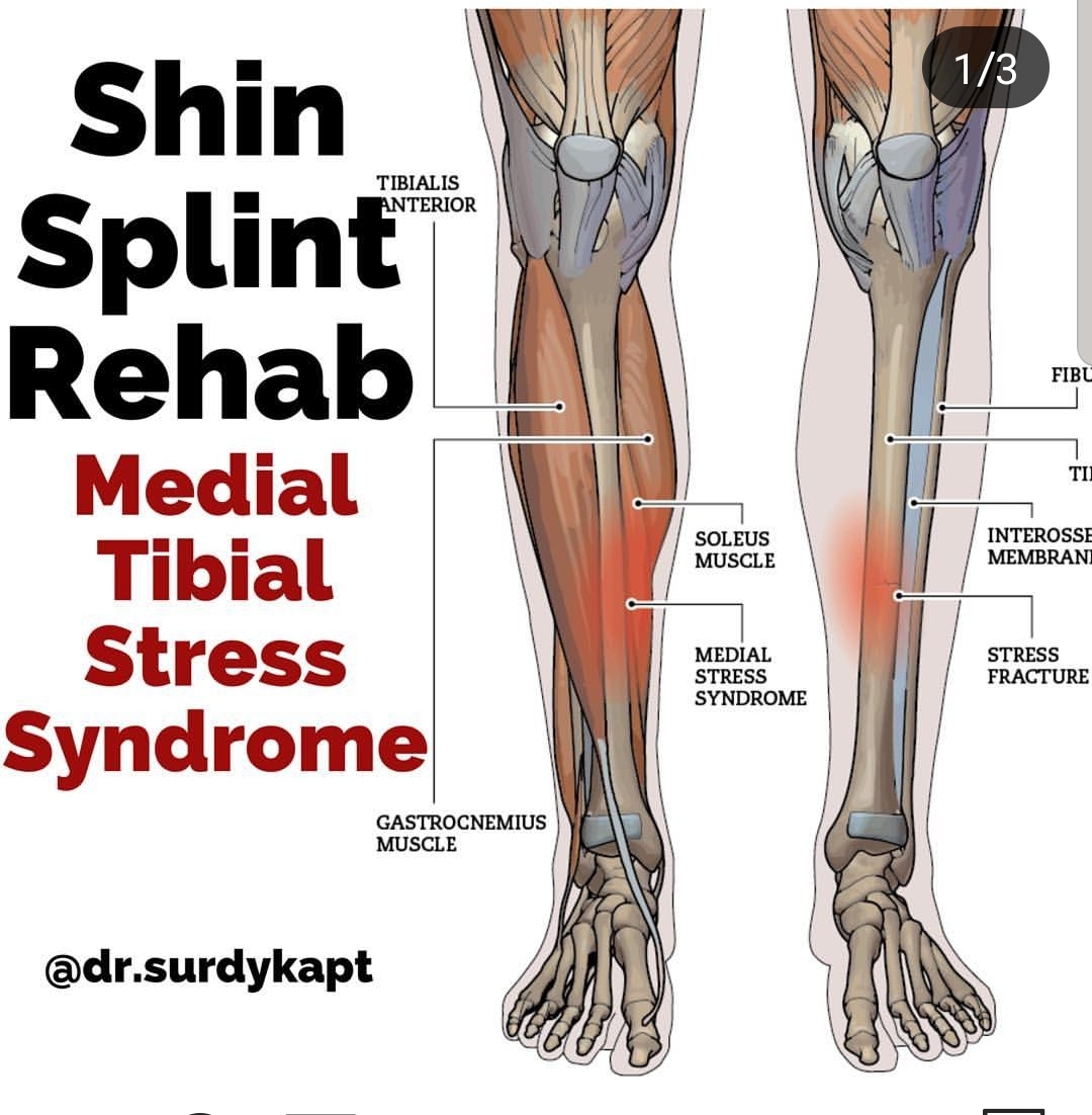 Move Forward From Your Shin Splints The Spot