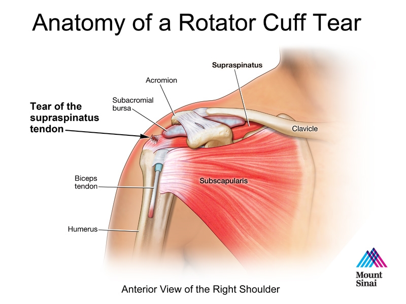 Anatomic description of degenerative rotator cuff tear. The common
