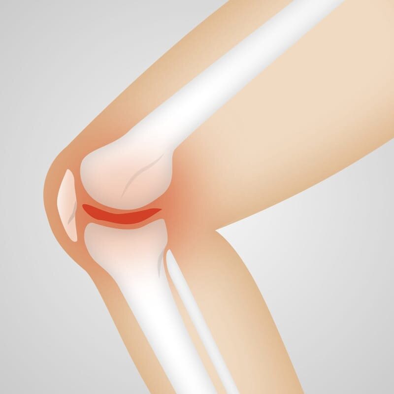 Will Knee Replacement Get Rid Of Arthritis? | Bella Vista Health ...