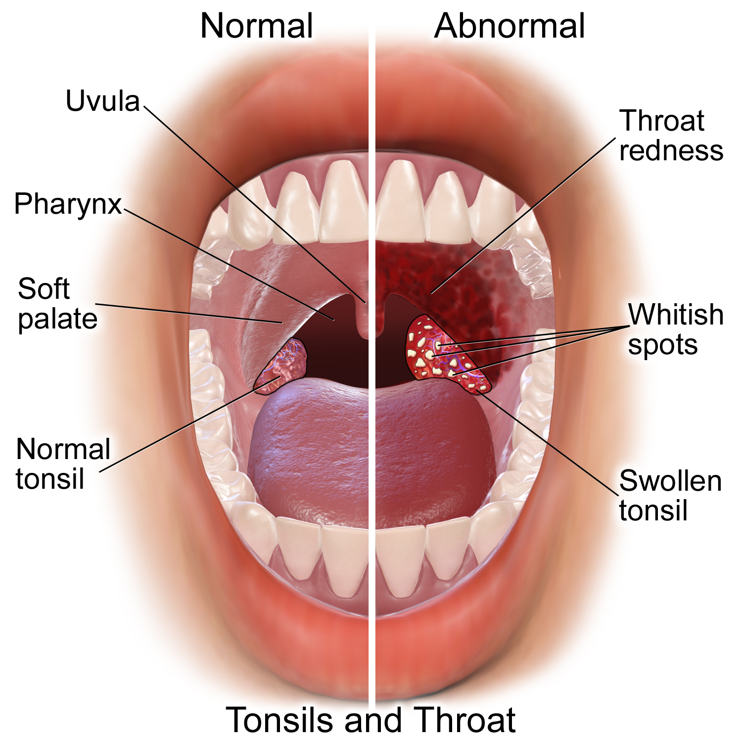 strep throat symptoms - things to watch for — physician 360
