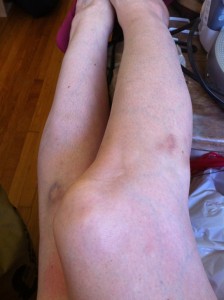 Bruise-y legs!!