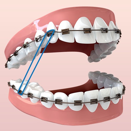 All About Elastic Rubberbands — Champion Orthodontics
