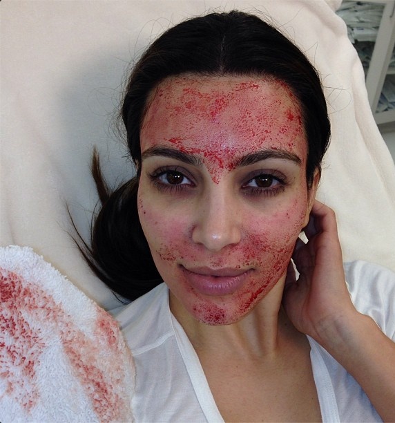 Kim Kardashian Vampire Blood Facial