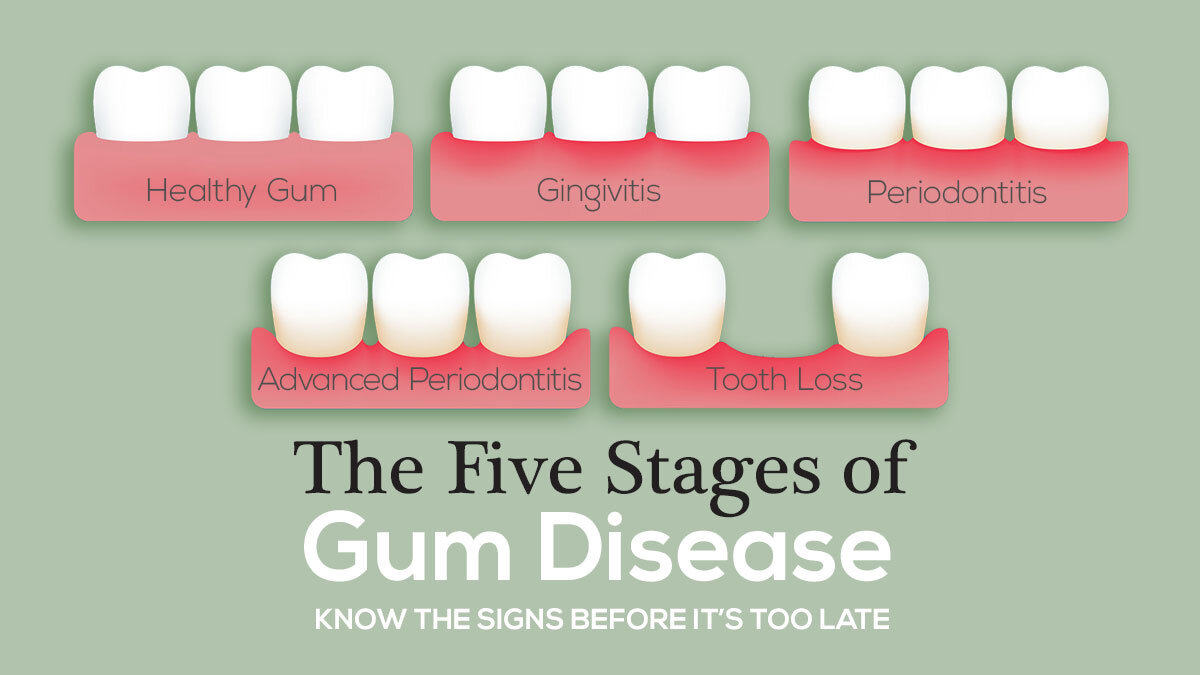 The Five Stages Of Gum Disease — The Mckenzie Center Implants