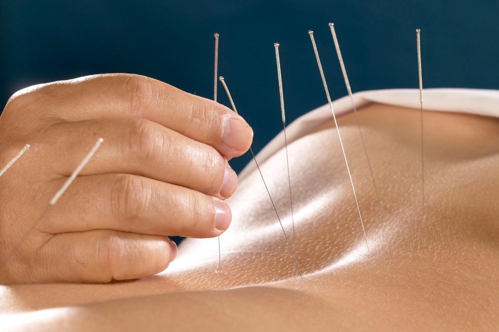  acupuncture acupuncturist pain relief therapy rehab rehabilitation East Brunswick NJ 