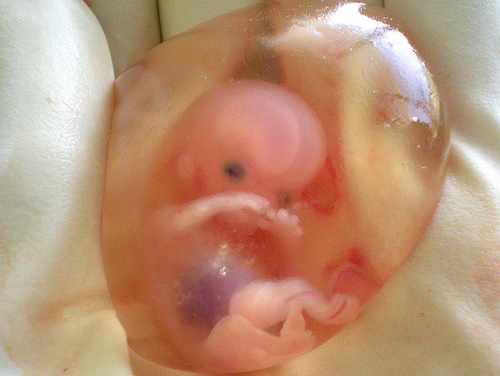 10 week old embryo baby. Taken by an OB/GYN med student in India named Dr. Suparna Sinha