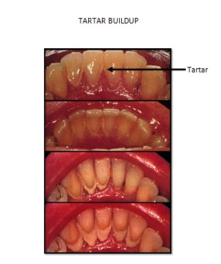 remove tartar on back of teeth
