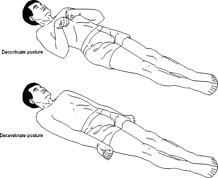  This is extension posturing. Doctors are able to determine injury types depending on the type of posture- And I am a child so I found the face on this drawing hilarious 