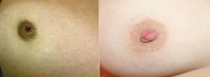 inverted nipple surgery