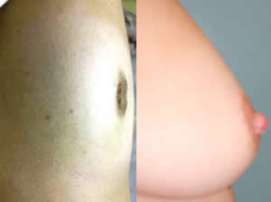 inverted nipple surgery