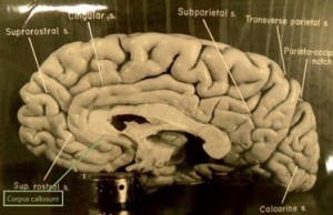 Imagen publicada en el artículo original. En el recuadro verde se nombra al cuerpo calloso, señalado en el cerebro.