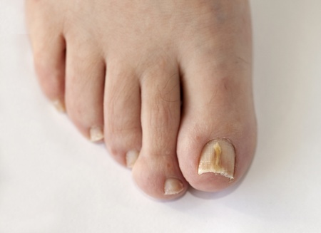 5 Easy Home Remedies for Summer Toenail Fungus — Valley Stream Podiatry