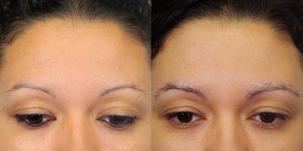 A comparative side-by-side before and after photo of a woman's eyebrows. The left shows the woman with sparse eyebrows before receiving Regeneris Medical's treatment, and the right shows enhanced brow growth after receiving Regeneris Medical's treatment.