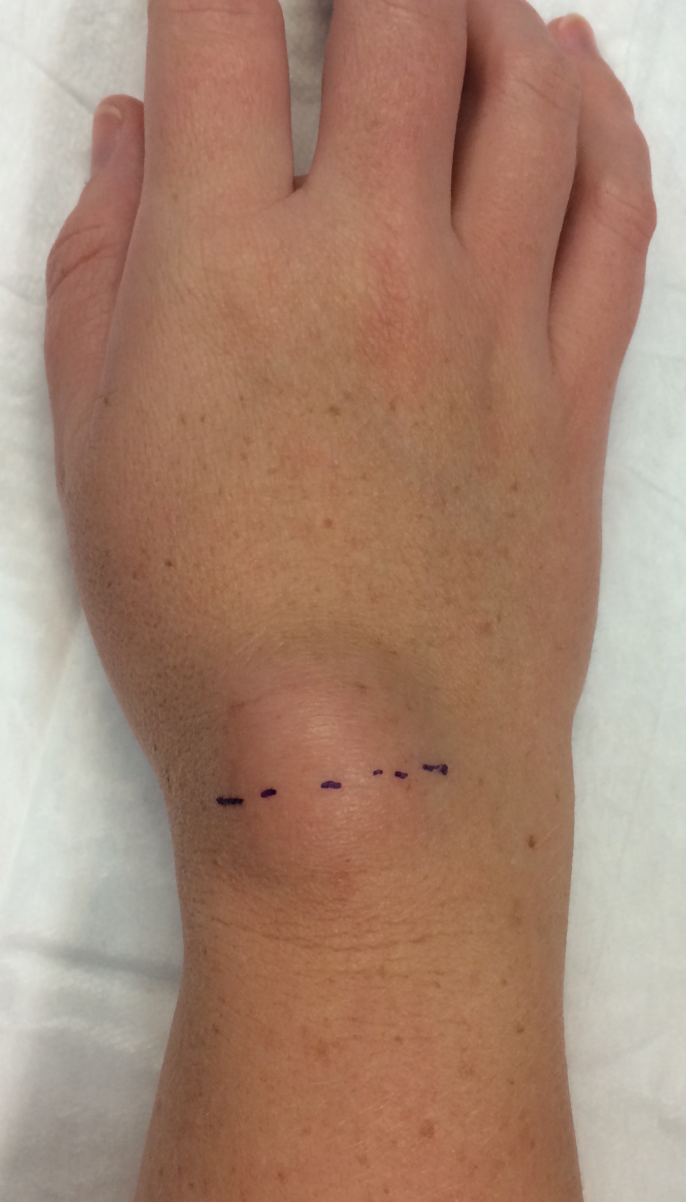 A wrist ganglion with surgery incision marked