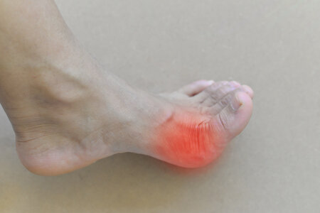 Do S And Don Ts For Dealing With Gout Nyspma New York State