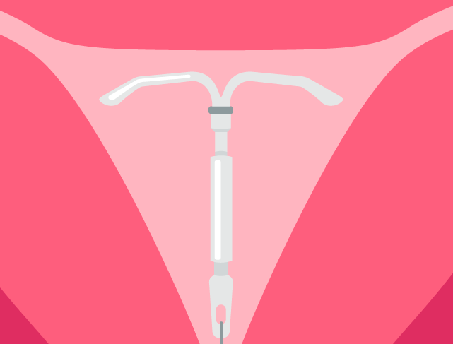 iud-removed_feature