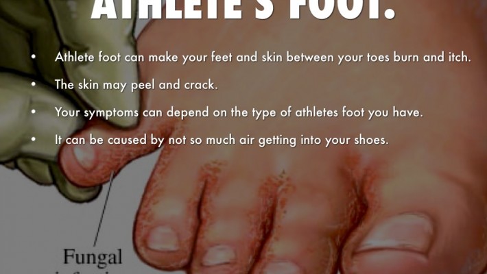 Athlete's Foot (Tinea Pedis) — Foot 