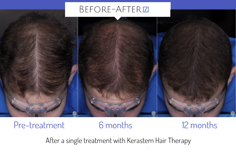 Everything you need to know about Stem Cell Therapy for Hair Loss |  Award-winning Plastic Surgeon | Dr. Rozina Ali