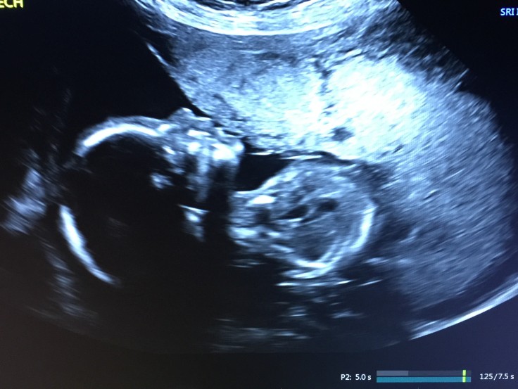 Poshusta baby #2 at 20 weeks 5-14-15
