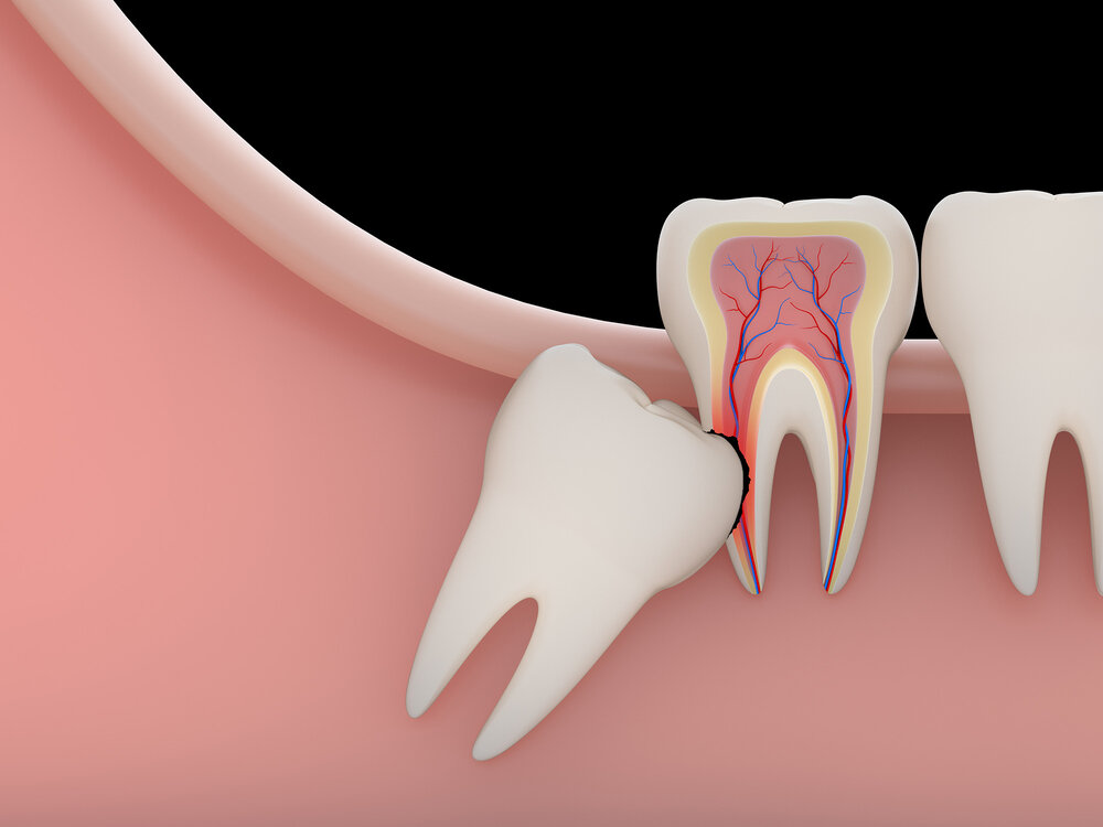 post op complications wisdom teeth extraction
