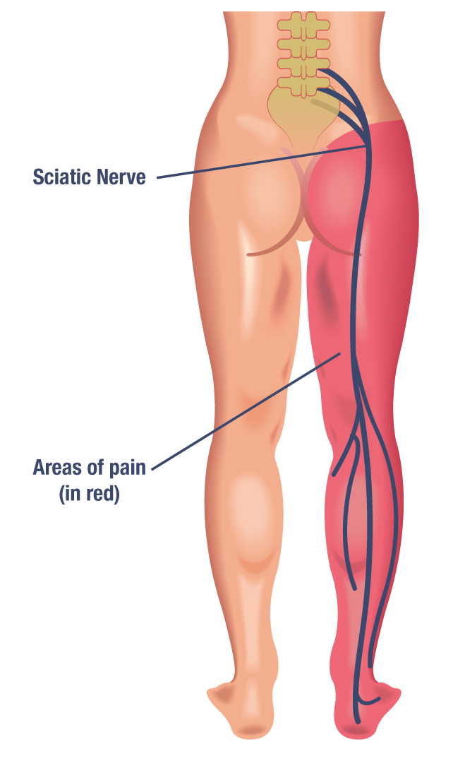 Image result for sciatic nerve