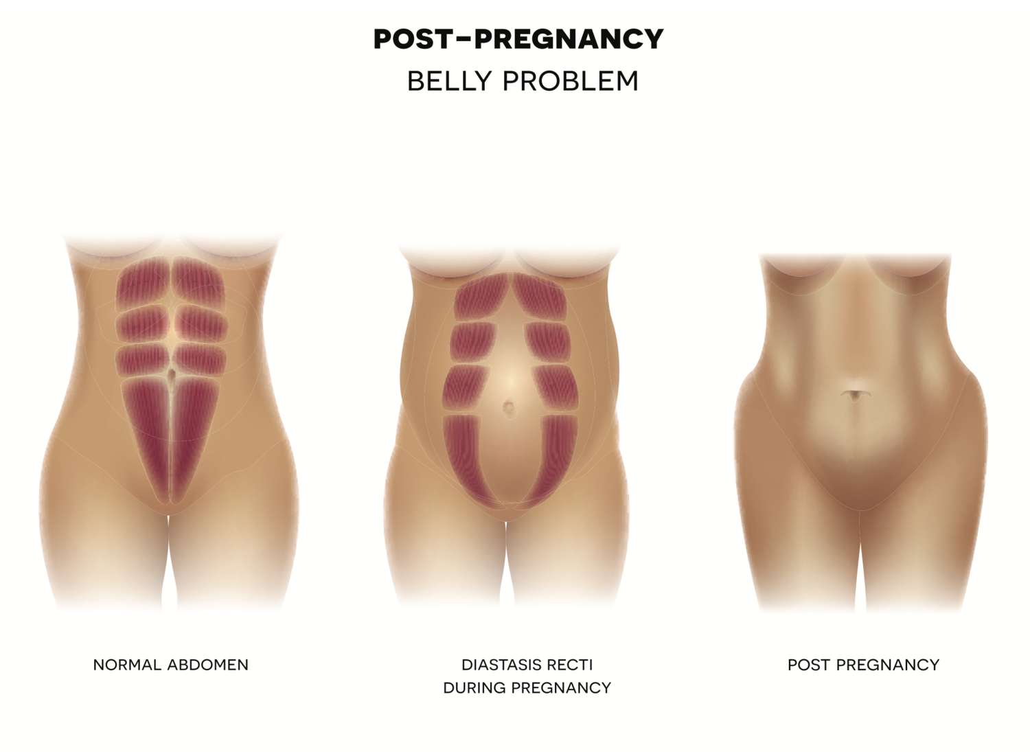 Diastasis Recti: The Five Things You Need To Know About Abdominal Injury -  Jackson County Physical Therapy
