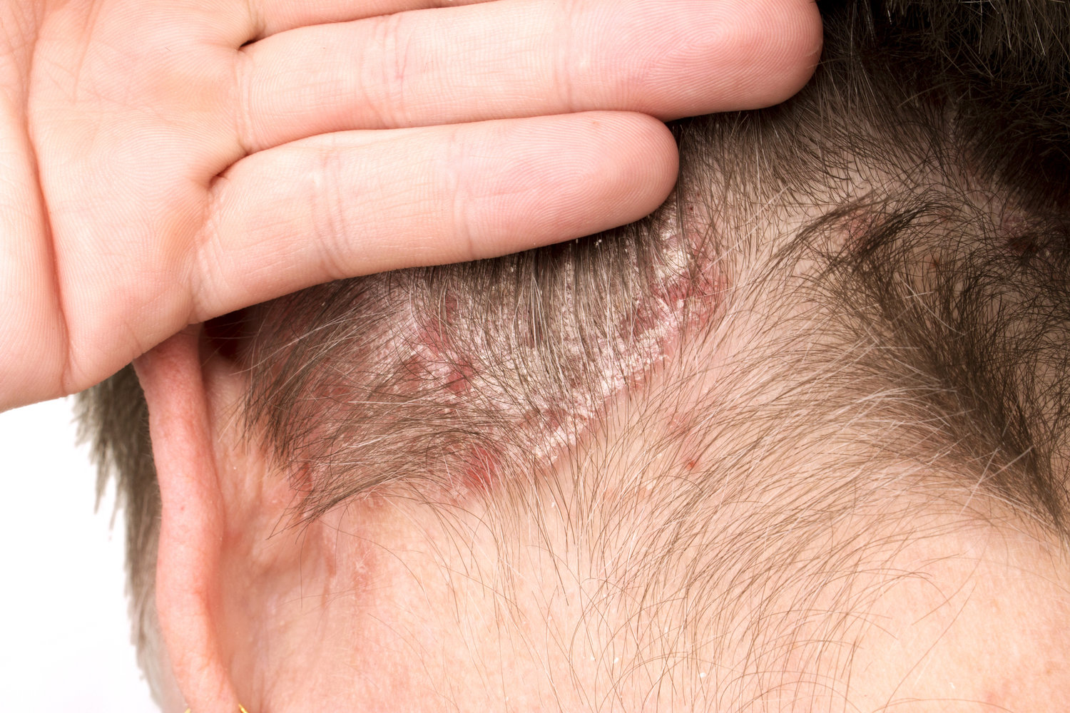 Everything You Need To Know About Seborrheic Dermatitis — Kapyderm USA