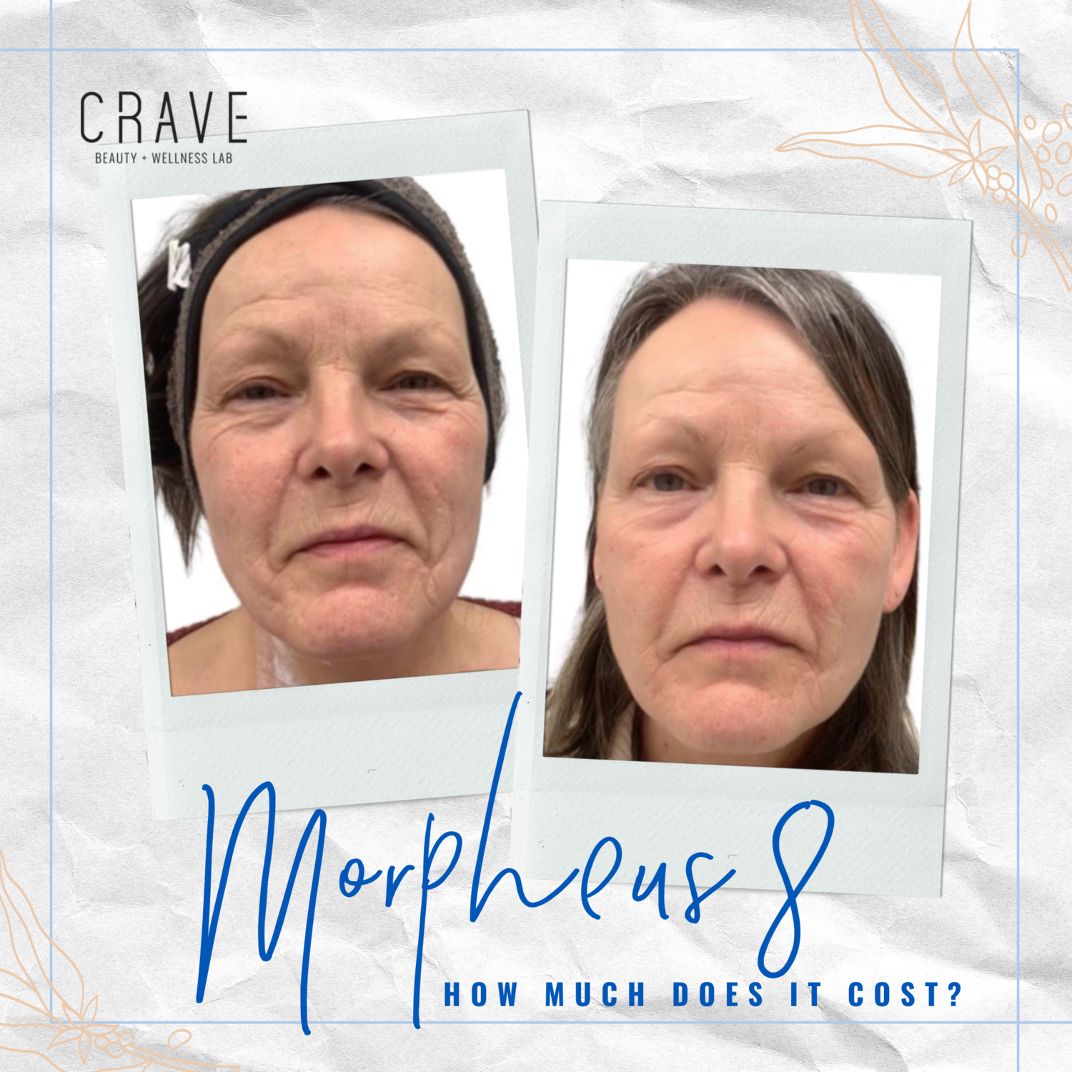 How Much Does Morpheus8 Treatment Cost? — CRAVE BEAUTY LAB