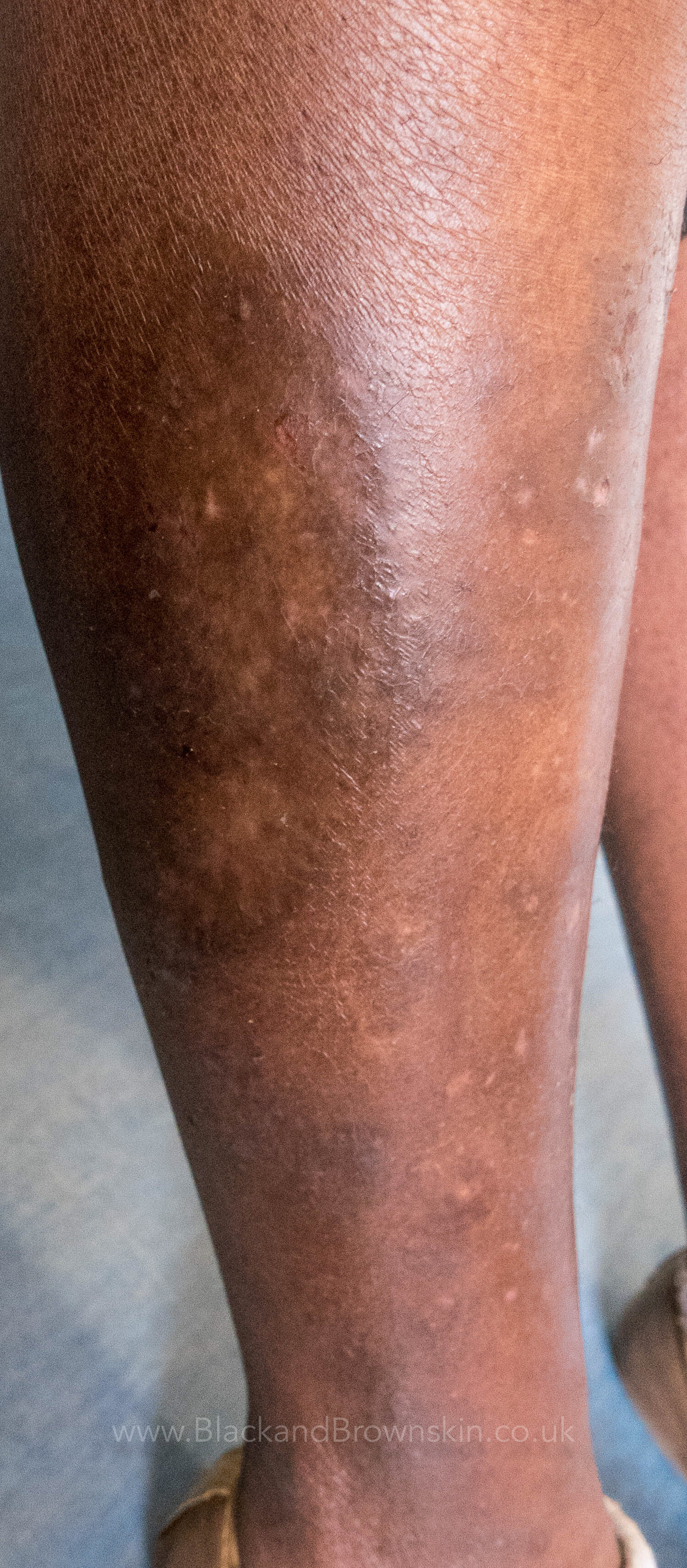 Eczema — Black And Brown Skin